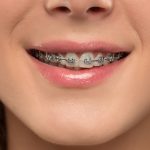 Jak powstają aparaty ortodontyczne?